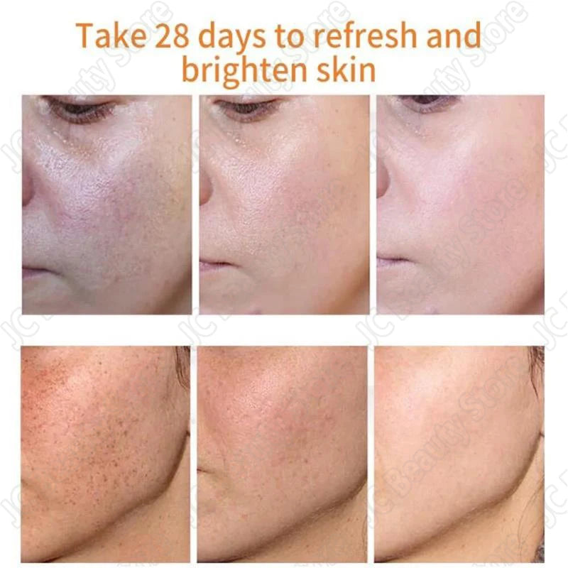 Whitening Freckle Cream Melasma Dark Spots Pigmentation Removal Products Fade Stain Melanin Repair Brighten Korean Skin Care - AdrenalineZone